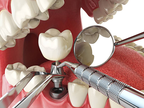 Best Emergency Root Canal Therapy in Danville, IN